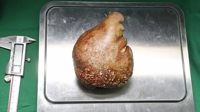 சிறுநீரகக்கல், அறுவை சிகிச்சை, இலங்கை ராணுவம் 