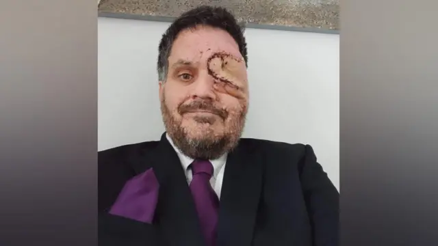 Oliver,supremapokerterno, sorrindo para a câmera. Ele tem pequenas protuberâncias no rosto e um retalho cutâneo com cicatriz no lugar do olho que foi removido. 