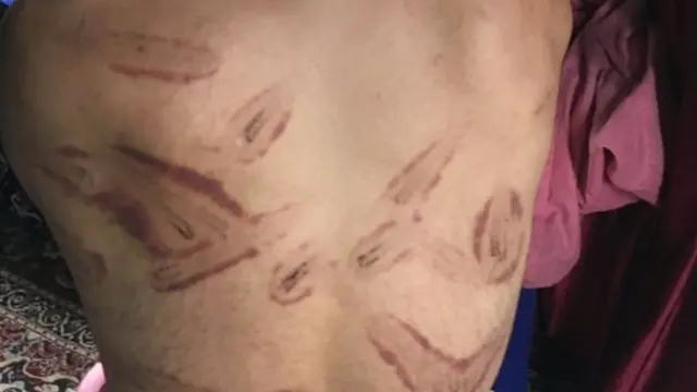 कश्मीर में एक व्यक्ति की पीठ पर टॉर्चर के निशान.