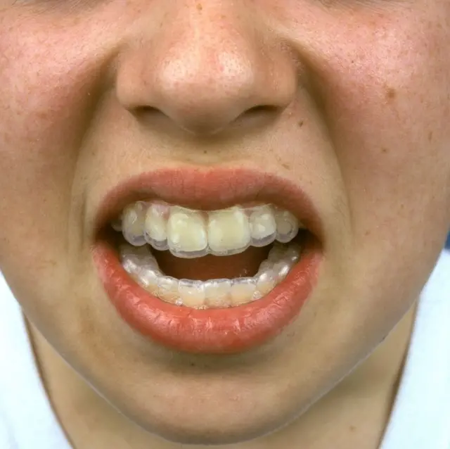 Niño con un alineador transparente