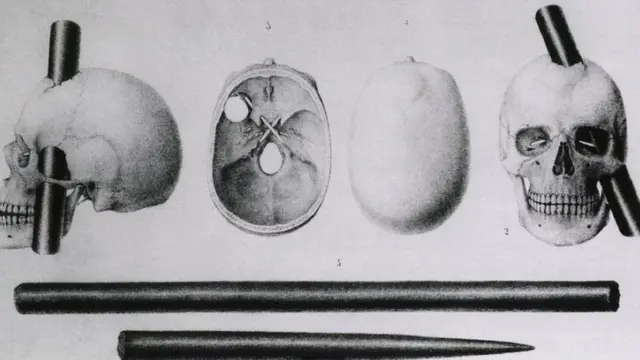Cráneo con barra de hierro.