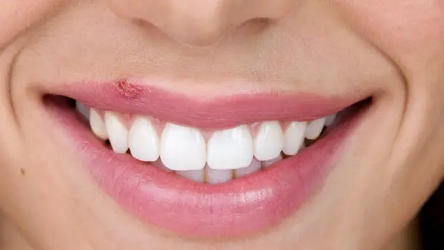 Mujer sonriendo con un herpes labial