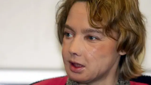 මුහුණේ බද්ධ කිරීම් සඳහා යොමු වූ පළමු කාන්තාව Isabelle Dinoire