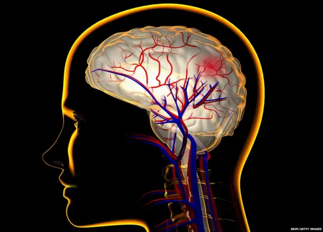 ਬ੍ਰੇਨ ਸਟ੍ਰੋਕ