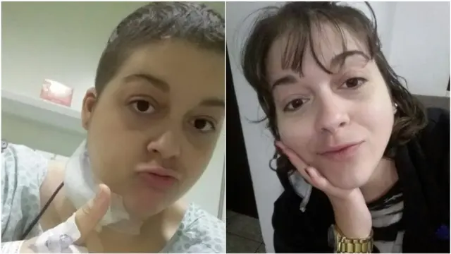 Júlia Masculi antes e depois do tratamento