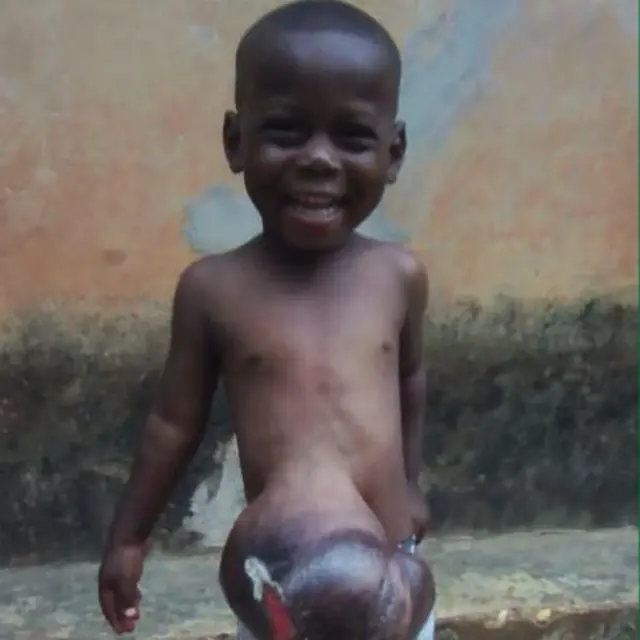 Hivi ndivyo alivyokuwa Ethan Suglo kabla ya kufanyiwa upasuaji nchini Uingereza