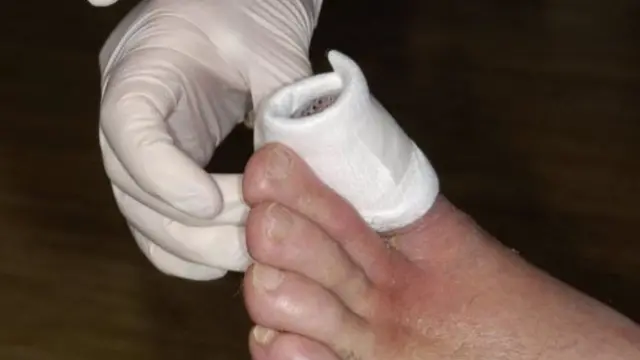 કોરોના વાઇરસના દરદીઓ માટ ગૅંગ્રીન કટલી જોખમી છે?