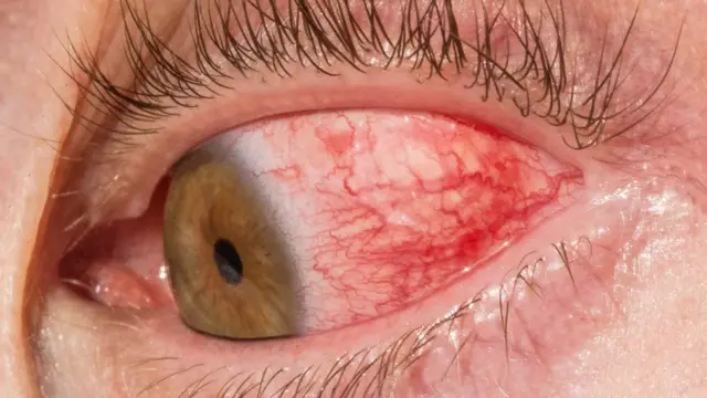 Ojo rojo e irritado