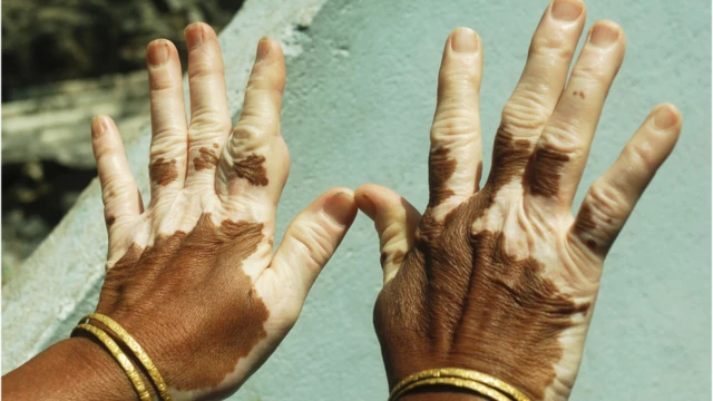 Les mains d'une femme atteinte de vitiligo