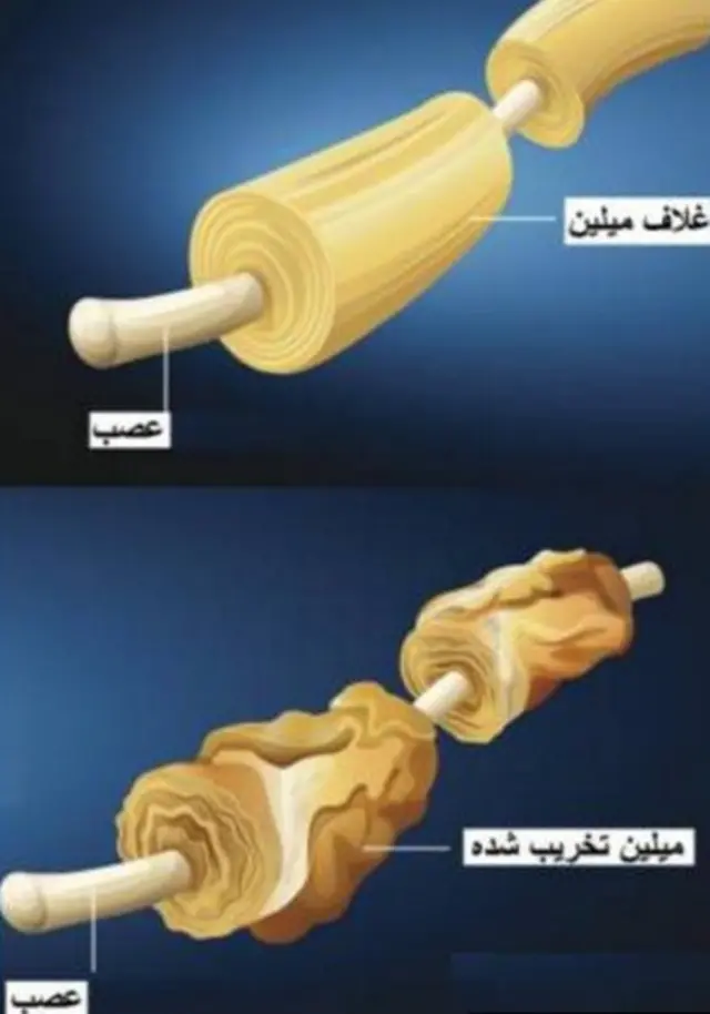 بیماری ام اس