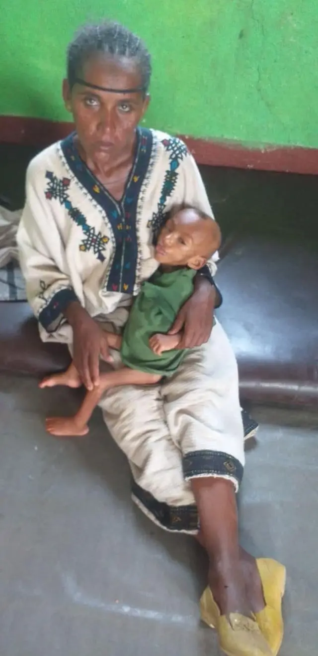 በምግብ እጥረት የተጎዳ ልጇን የያዘች እናት