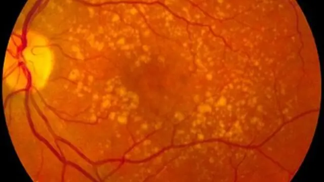Globo ocular con degeneración macular
