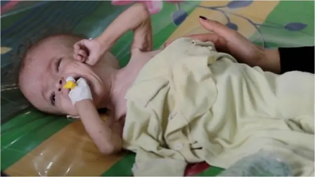 Isbitaallada Yemen waxaa ka tan badiyey kiisaska soo gaaraya