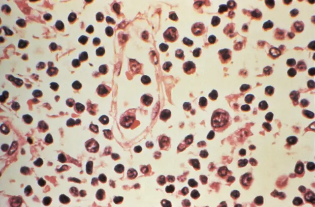 Amostra de linfonodo extraída de um paciente com suspeita de infecção por hantavírus 