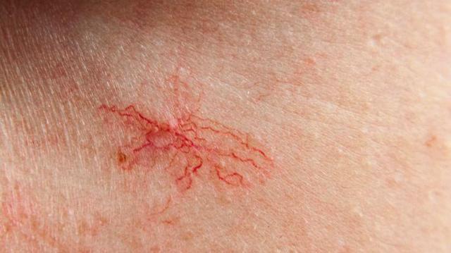 aranhas vasculares na pele