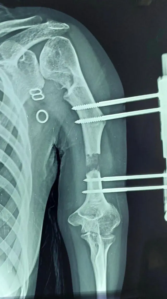 பெண்ணுக்கு 14 செ.மீ. எலும்பை வளரவைத்து அரசு மருத்துவர்கள் சாதனை