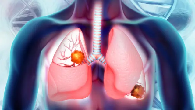 ফুসফুসের ক্যান্সারে আক্রান্তদের মধ্যে ৫২০০ জনই পুরুষ।