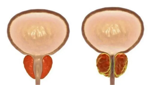 ప్రోస్టేట్ క్యాన్సర్