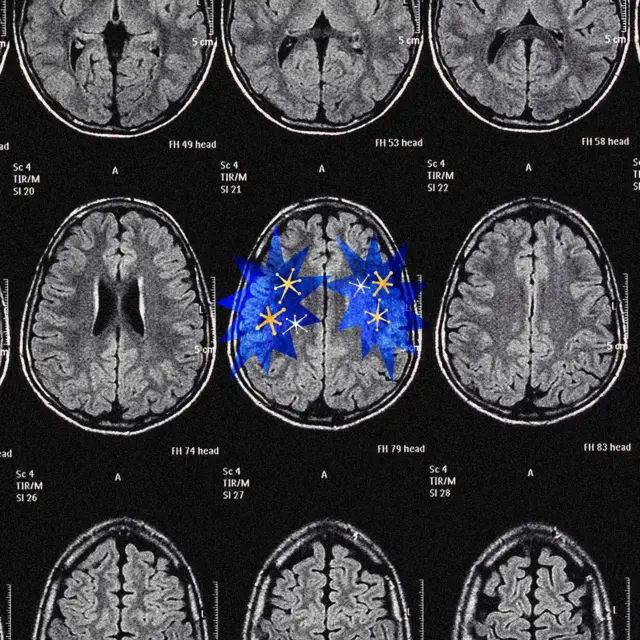 Колаж - зображення кількох сканів мозку на чорному тлі, на середньому - виділені сині зони наче спалахи із жовтими зірочками всередині