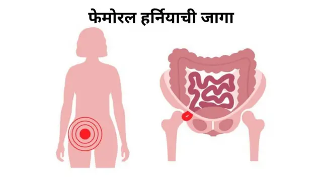 फेमोरल हर्निया म्हणजे काय? महिलांनी काय काळजी घ्यायची?