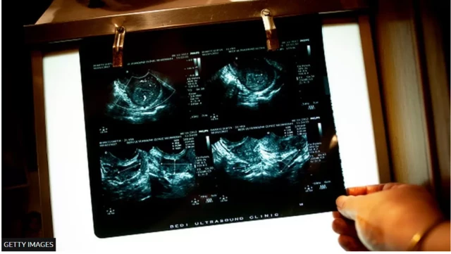 ကိုယ်ဝန်ဖျက်ချခွင့်