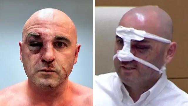 لِوان خابیشویلی، رهبر حزب اصلی اپوزیسیون «جنبش ملی متحد» عکسی از صورت کبود خود را در شبکههای اجتماعی منتشر کرد