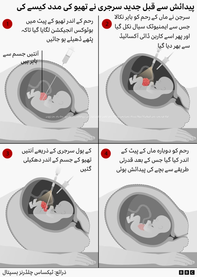 Infographic showing a four-step prenatal surgery. The foetus is given a Botox injection in the abdominal wall to relax the muscles, surgeons temporarily open the womb and use keyhole surgery to move a foetus’s intestines back inside the body before returning the uterus, allowing the pregnancy to continue until the healthy baby is born naturally.