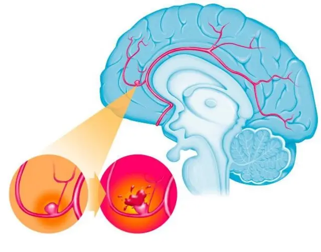 یہ گومڑ جب پھٹ جاتا ہے تو جان لیوا ہو سکتا ہے
