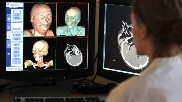 ਇੱਕ ਡਾਕਟਰ ਕੰਪਿਊਟਰ ਸਕਰੀਨ ਉੱਤੇ ਖੋਪੜੀ ਦੀਆਂ ਤਸਵੀਰਾਂ ਦੇਖਦੇ ਹੋਏ