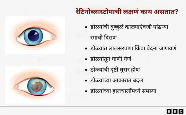 डोळ्यांचा आजार
