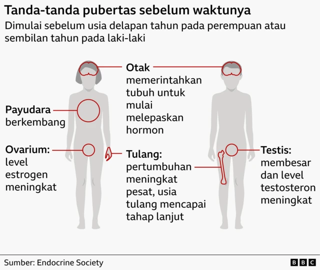 Ilustrasi grafis tubuh laki-laki dan perempuan yang memberi label tanda-tanda pubertas prekoks pada anak-anak.