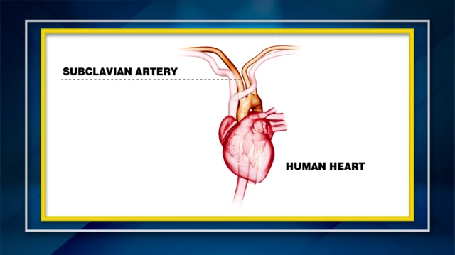 E-ray of Obumsile wey show di impact of di stab