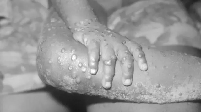 Onye na-arịa ọrịa Mpox