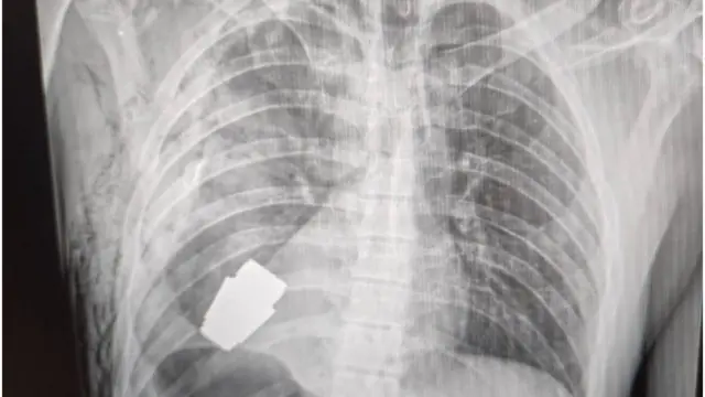 ఛాతిలో గ్రెనెడ్ 