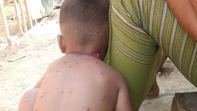 ကျောက်တော်က စစ်ဘေးရှောင်စခန်းတချို့မှာ ကျောက်ရောဂါဖြစ်ပွားနေ