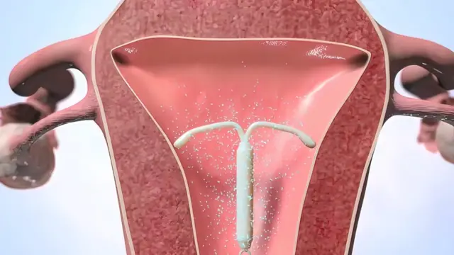 Les femmes plus âgées optent souvent pour un stérilet, hormonal ou non.