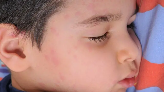 Niño con sarampión.