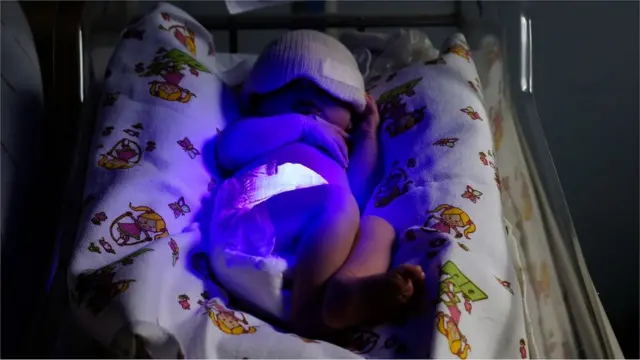 నొప్పి లేని ఫోటోథెరపీ వైద్యం ద్వారా బిడ్డకు పచ్చకామెర్లు తగ్గించవచ్చు