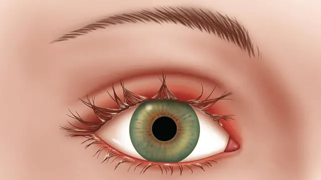 Blepharitis