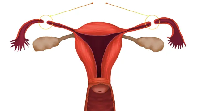 Diagram showing female sterlization