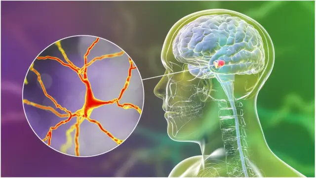 પાર્કિન્સન્સ