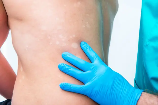 La mano de un médico examina las manchas en el torso de un hombre