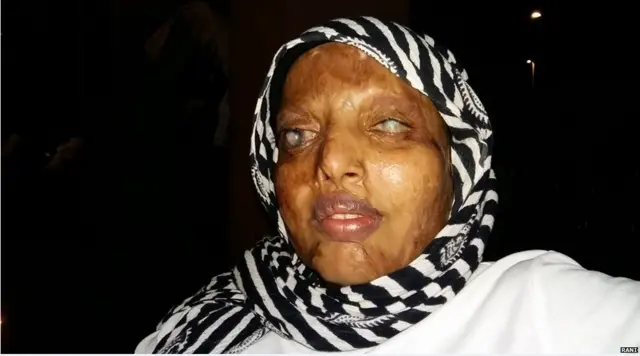 तेज़ाबी हमला