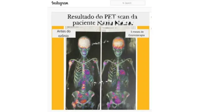 Postagem no Instagram mostra duas imagensestrela bet jogo aviatortomografia, a mais recente com menos manchas no corpo