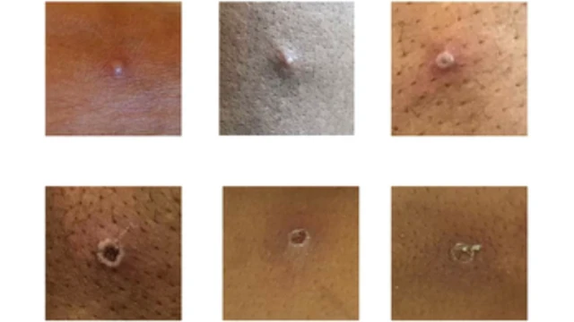 মাংকি পক্সের গুটি