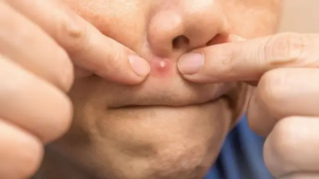 முகப்பரு எந்த வயதிலும் ஏற்படலாம் என்றாலும், இந்த வயதினரிடையே இது மிகவும் பொதுவானது. மாசுபாடு மற்றும் தூசு தோலில் உள்ள துளைகளை அடைத்து வீக்கத்தை உண்டாக்குகின்றன. காற்றில் உள்ள மாசுக்கள் 'ஆக்ஸிஜனேற்ற அழுத்தத்தை' அதிகரித்து, தோலை அதிக உணர்திறன் கொண்டதாக மாற்றுகின்றன.
