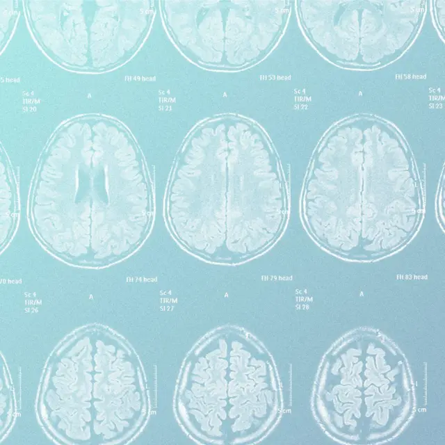 માઇગ્રેન એટલે શું, માઇગ્રેન કેમ થાય છે, માઇગ્રેન એટલે આધાશીશી, માઇગ્રેન ઉપર અભ્યાસ, આધાશીશીનો ઇલાજ અને સારવાર, સંશોધન, બીબીસી ગુજરાતી