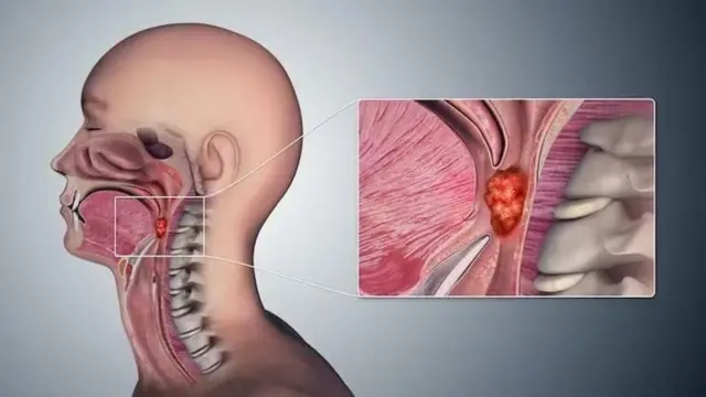 Ilustraçãoyuvraj singh 1xbetonde fica a orofaringe 