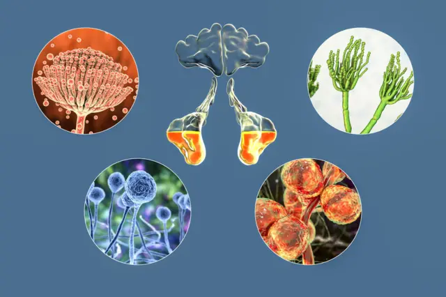 गैरसमज आणि उत्तर सायनस म्हणजे काय?