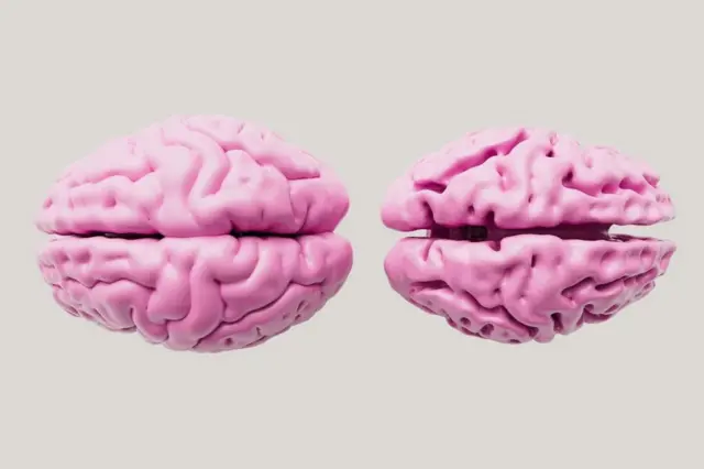 Mchoro uliotengenezwa kwa kompyuta unaoonyesha tofauti kati ya ubongo wenye afya (kushoto) na ubongo ulioathiriwa na ugonjwa wa Alzheimer (kulia).